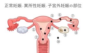 子宮外妊娠の症状とは｜治療症例や検査方法